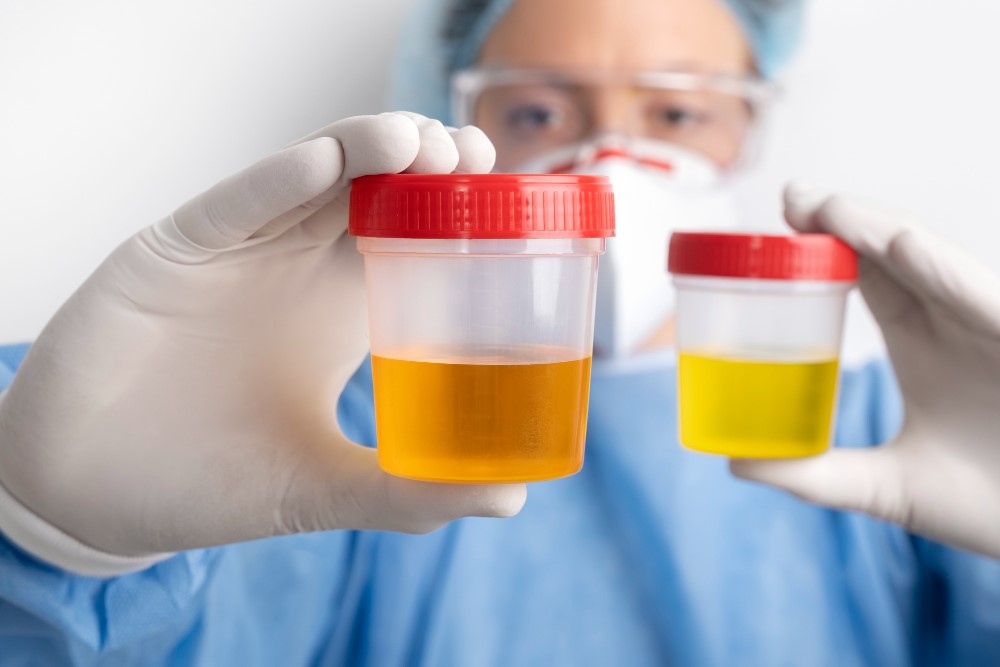 Quanto Tempo O Exame De Urina Detecta Drogas 1